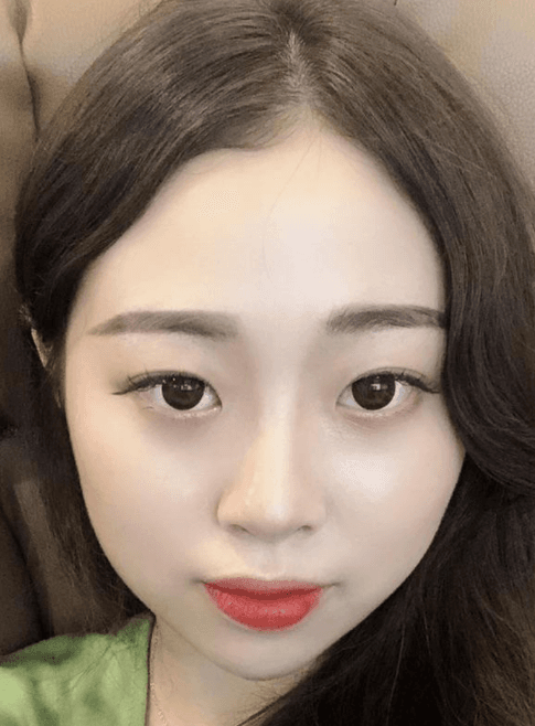 이제 딱 한달차네요!! 수술후기 사진 2