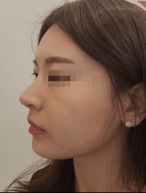 만족100프로에요 수술후기 사진 2