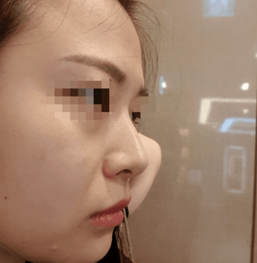 만족100프로에요 수술후기 사진 3