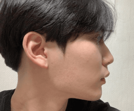 한달차 입니다! 수술후기 사진 2
