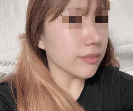 좀더 빨리 할걸! 수술후기 사진 2