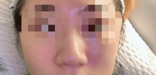 좀더 빨리 할걸! 수술후기 사진 4