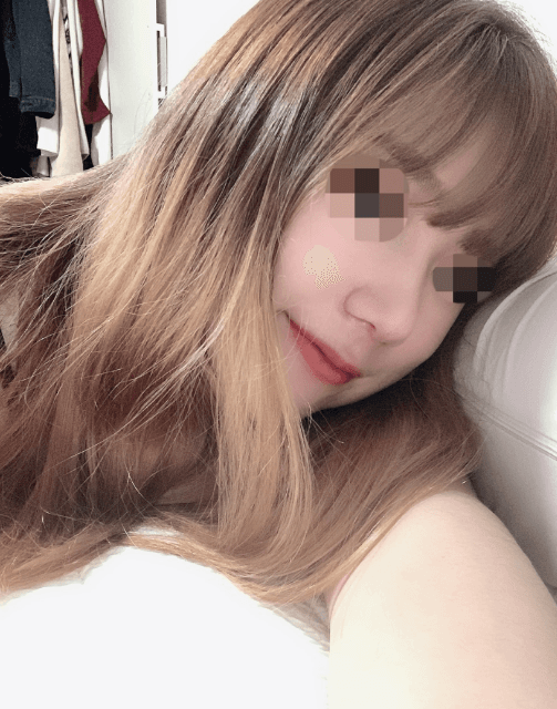 좀더 빨리 할걸! 수술후기 사진 3