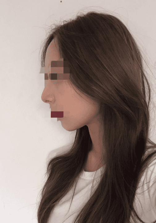 코 무턱보형물 눈밑지방재배치 8일차♥ 수술후기 사진 2
