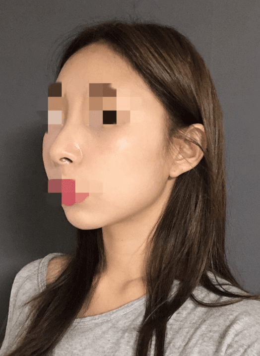 코 무턱보형물 눈밑지방재배치 8일차♥ 수술후기 사진 3