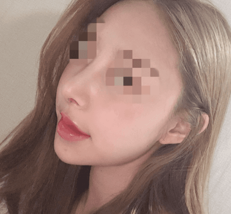 코 무턱보형물 눈밑지방재배치 8일차♥ 수술후기 사진 4