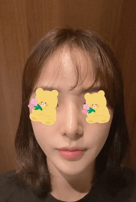 너무 예뻐용 수술후기 사진 3