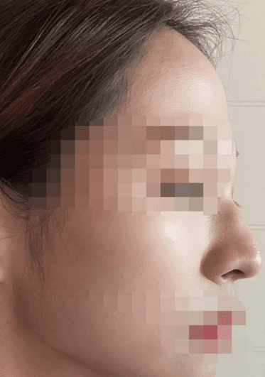 점점 자연스러워져서 좋아요 ㅎㅎㅎㅎ 수술후기 사진 2