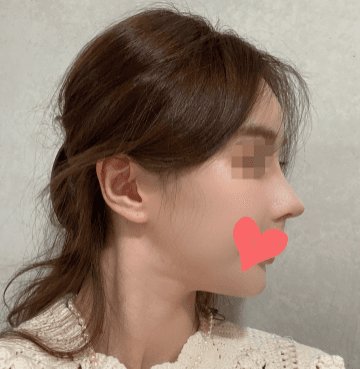 이쁘죠?? 수술후기 사진 2