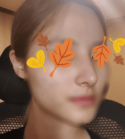 오 벌써 코수술 한지 2달치 흘렀네요 ㅎㅎ 수술후기 사진 2
