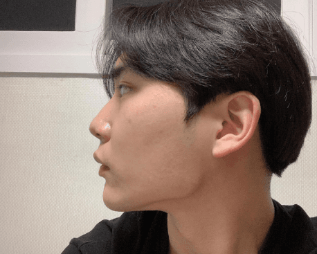 후회 절대 안하는게 너무 좋습니다 수술후기 사진 2