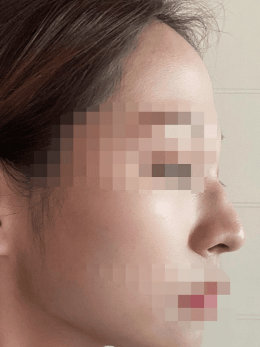 코수술 한지 한달차 입니당 ㅎㅎ 수술후기 사진 2