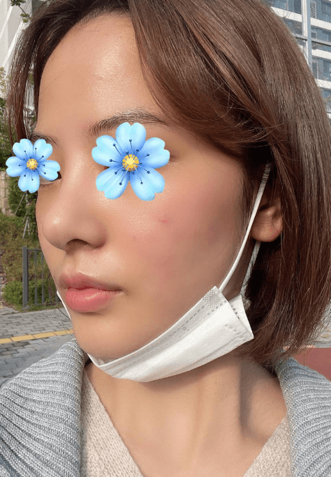 최고인것 같습니다!! 수술후기 사진 2
