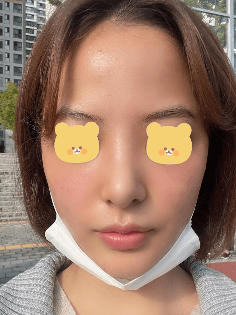 최고인것 같습니다!! 수술후기 사진 3