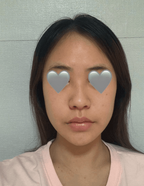 김형택 원장님 라인하나는 진짜 최고인것 같아요♥♥♥ 수술후기 사진 2