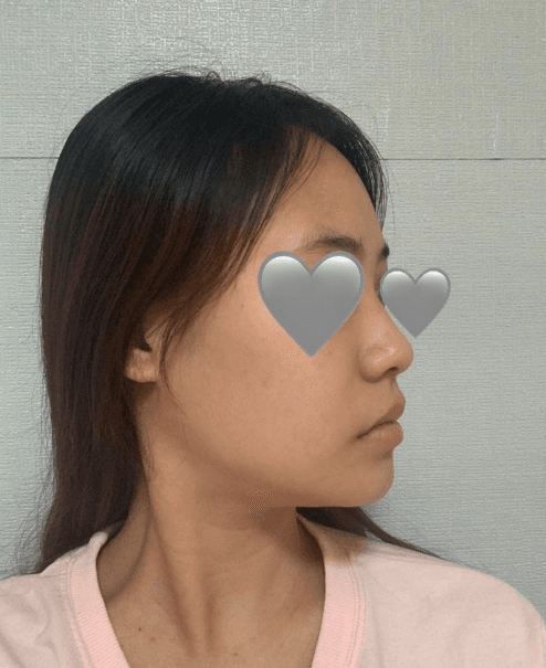 김형택 원장님 라인하나는 진짜 최고인것 같아요♥♥♥ 수술후기 사진 4