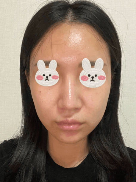 코원성형외과에서 코 재수술한지 2달차입니당 수술후기 사진 4