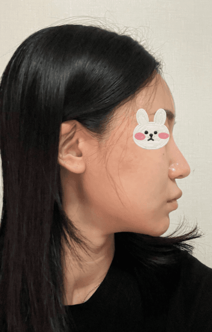 코원성형외과에서 코 재수술한지 2달차입니당 수술후기 사진 3