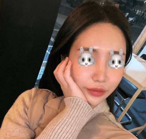 코원성형외과에서 코 재수술한지 2달차입니당 수술후기 사진 2