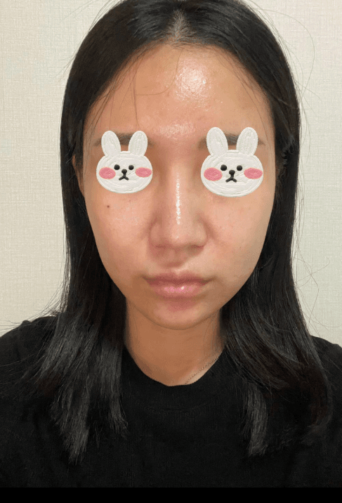 전후차이 보면 너무 신기해요 수술후기 사진 3