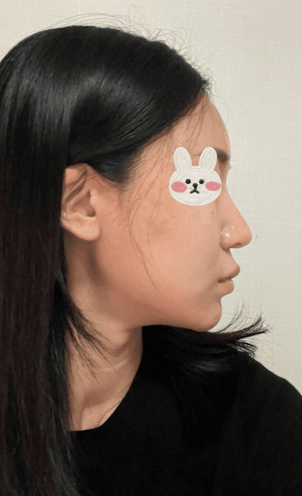 전후차이 보면 너무 신기해요 수술후기 사진 4