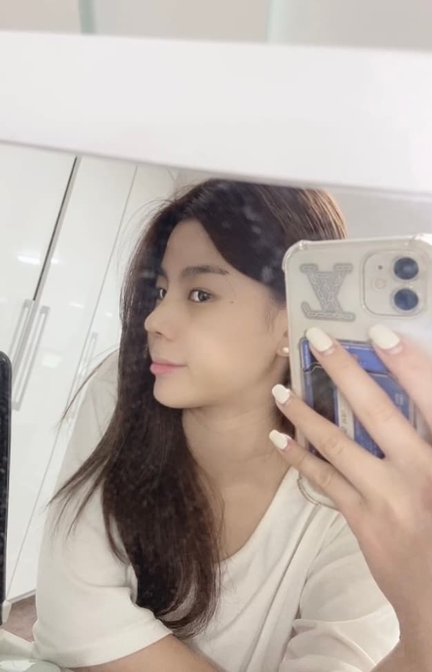 기뻐서 울뻔 했어요 ㅎㅎ 수술후기 사진 3