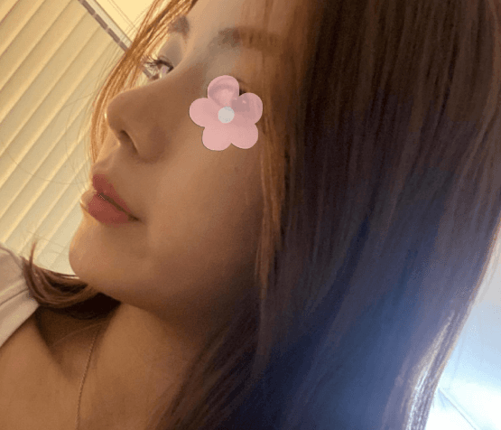 제자신을 무척 칭찬해요ㅎㅎ 수술후기 사진 2