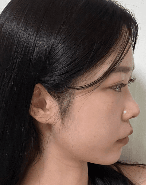 코원 원장님 ㄹㅇ 금손.. ㅠㅠㅠ 수술후기 사진 3