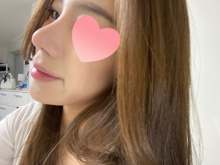좀 화려한 스타일로 재수술을 받았습니다. 수술후기 사진 2