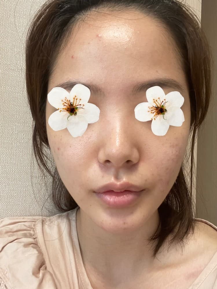 정말 만족 합니다 너무 예뻐용 수술후기 사진 5
