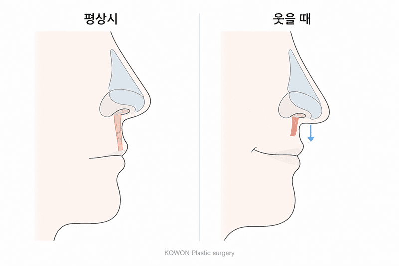 웃을 때 코끝 내려오는 건 근육 때문이라던데 근육교정은 어떤 수술인가요?