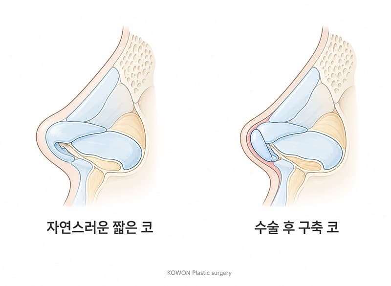 코수술부작용으로 들창코가 됐어요, 일반 들창코랑 수술방법이 다른가요?