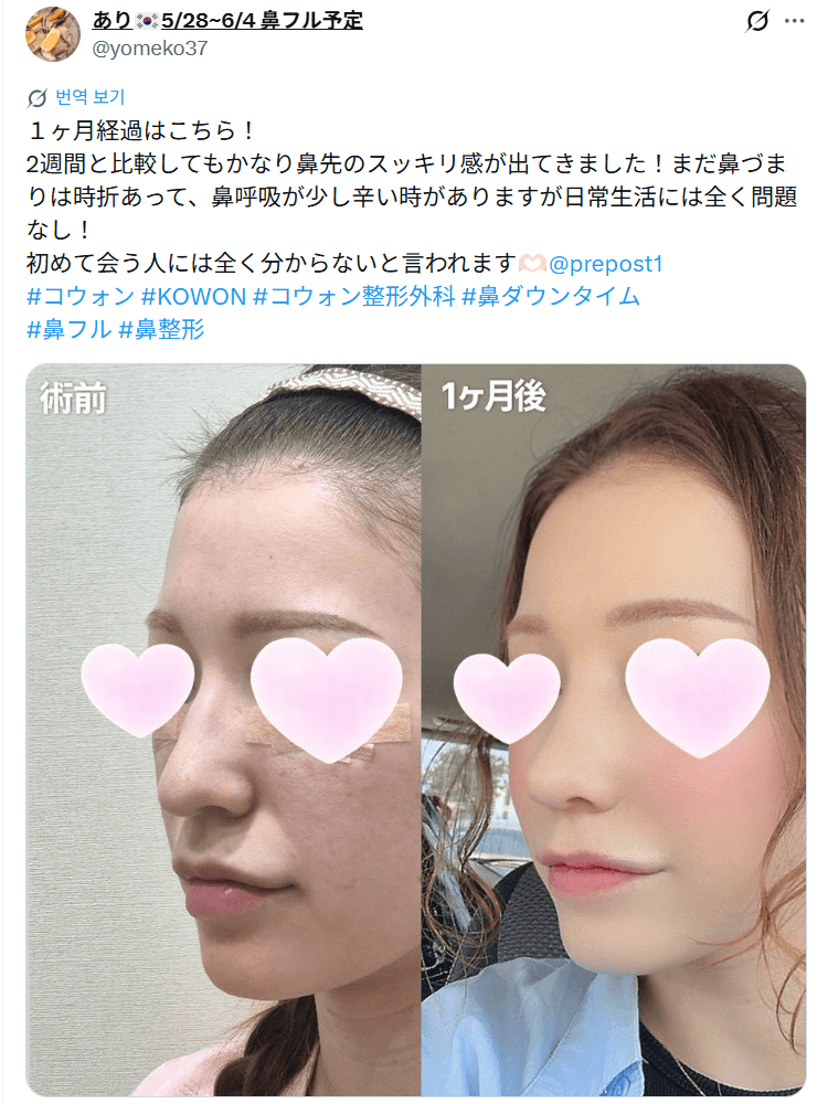 환자수술후기 — 「鼻先のスッキリ感が出てきました」鼻整形1ヶ月