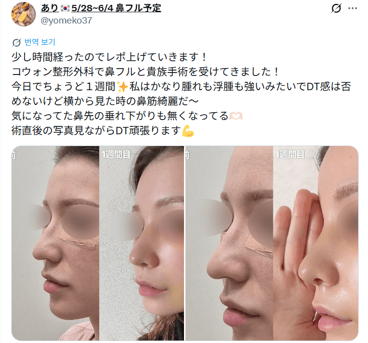환자수술후기 — 「気になっていた鼻先の垂れ下がりもなくなってる」鼻整形1週間