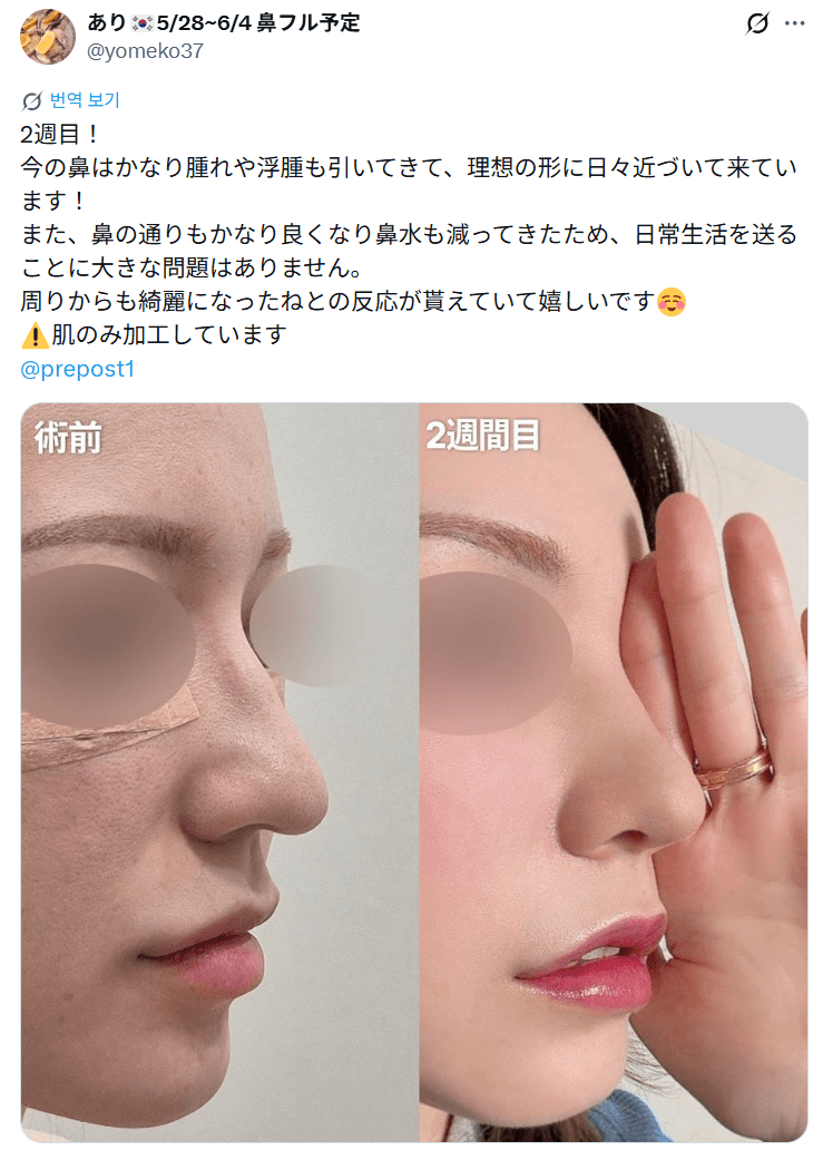 환자수술후기 — 「理想の形に日々近づいています」鼻整形2週間