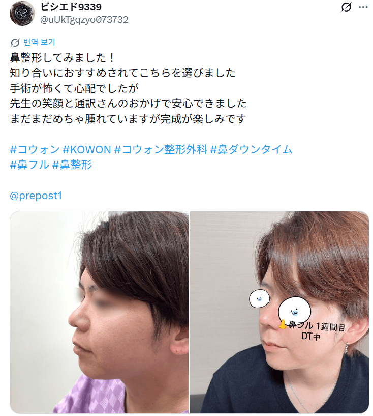 환자수술후기 — 「まだまだめちゃ腫れていますが完成が楽しみ」鼻整形1週間