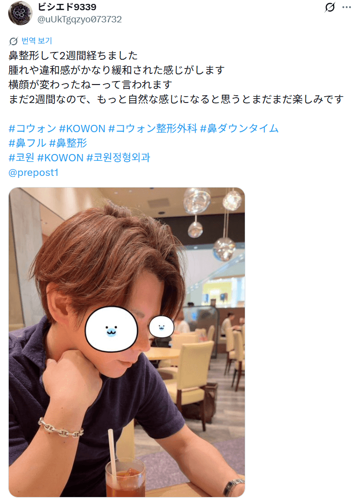 환자수술후기 — 「腫れや違和感がかなり緩和されました」鼻整形2週間