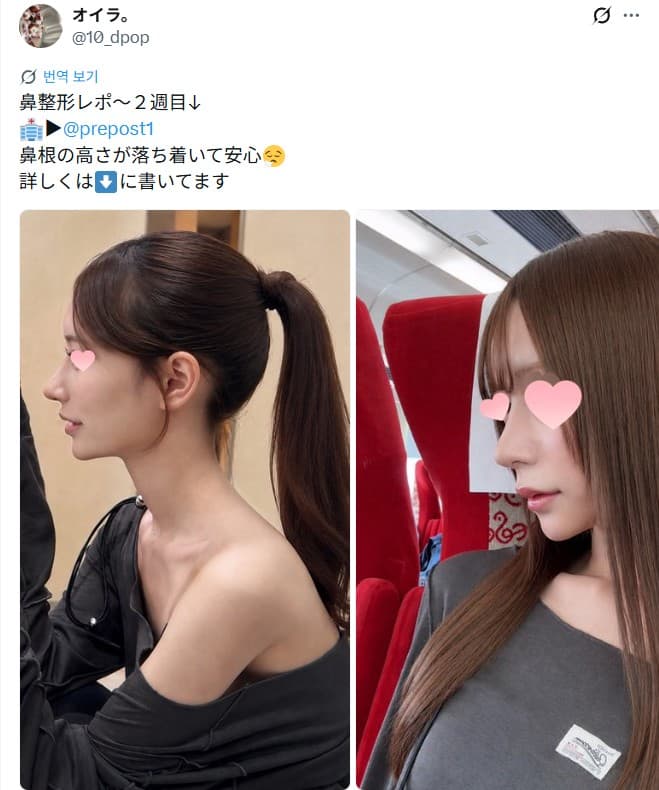 รีวิวหลังผ่าตัดของผู้ป่วย — 「鼻根の高さが落ち着いて安心」鼻整形2週間