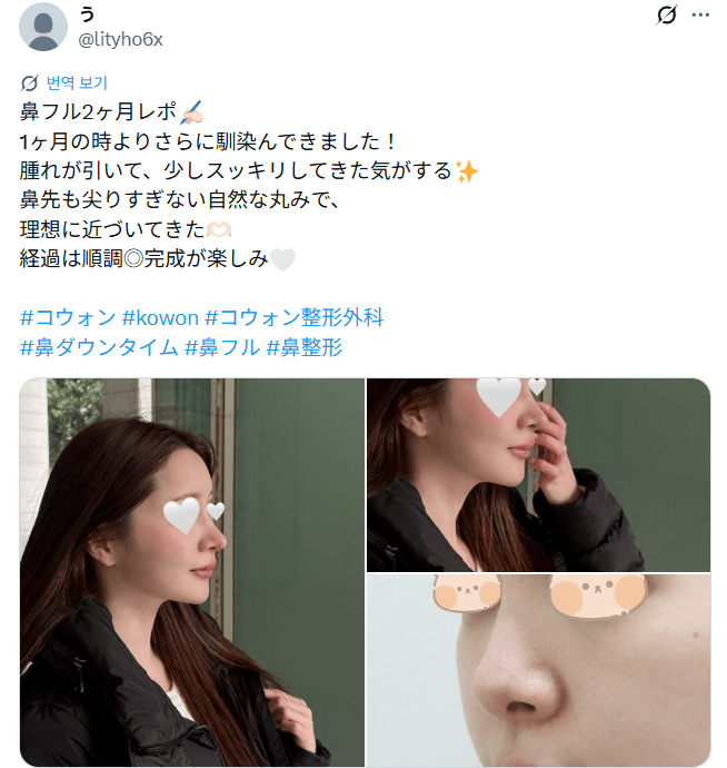 환자수술후기 — 「周りからも鼻良い感じになってきたね」鼻整形2ヶ月