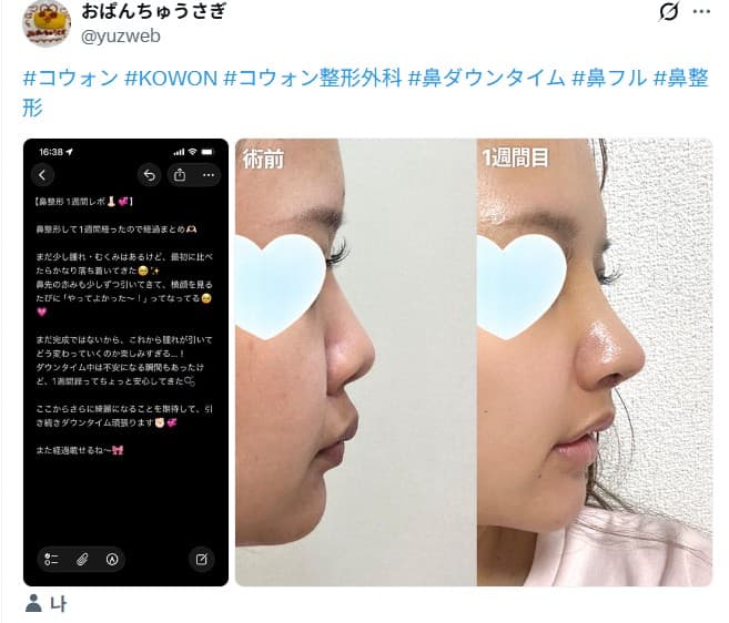 รีวิวหลังผ่าตัดของผู้ป่วย — 「横顔を見るたびにやってよかった」鼻整形1週間