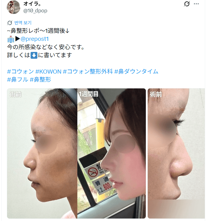 환자수술후기 — 「今の所感染などなく安心です」鼻整形1週間
