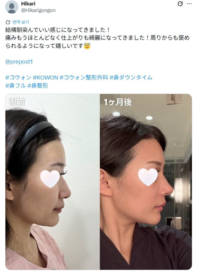 รีวิวหลังผ่าตัดของผู้ป่วย — 「仕上がりも綺麗になってきました」鼻整形1ヶ月