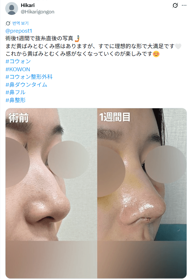 환자수술후기 — 「まだ完成ではないけどかなりいい」鼻整形1週間