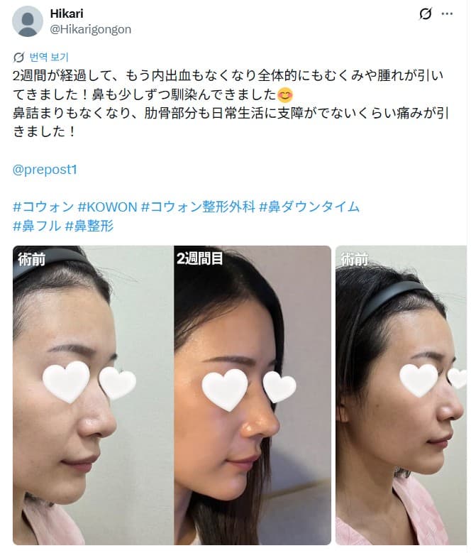 รีวิวหลังผ่าตัดของผู้ป่วย — 「鼻も少しずつ馴染んできました」鼻整形2週間