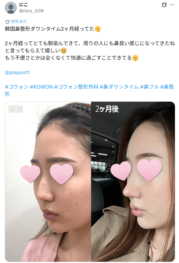 환자수술후기 — 「周りから鼻良い感じになってきたね」鼻整形2ヶ月