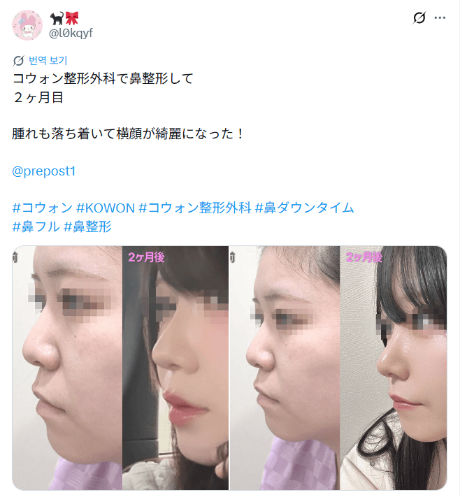 รีวิวหลังผ่าตัดของผู้ป่วย — 「腫れも落ち着いて横顔が綺麗になった」鼻整形2ヶ月