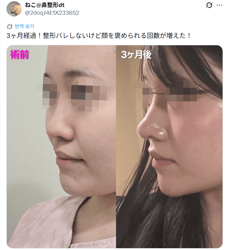 환자수술후기 — 「顔を褒められる回数が増えた」鼻整形3ヶ月
