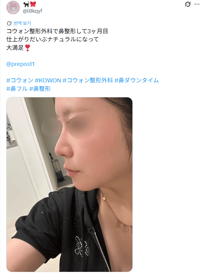 환자수술후기 — 「かなり馴染んできて初対面ではわからない」鼻整形3ヶ月