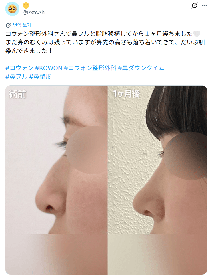 환자수술후기 — 「まだむくみはあるけど鼻先の高さも落ち着いてきた」鼻整形1ヶ月