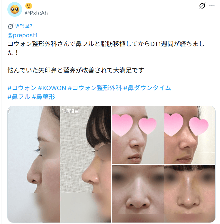 환자수술후기 — 「矢印鼻と鷲鼻が改善されて大満足」鼻整形1週間